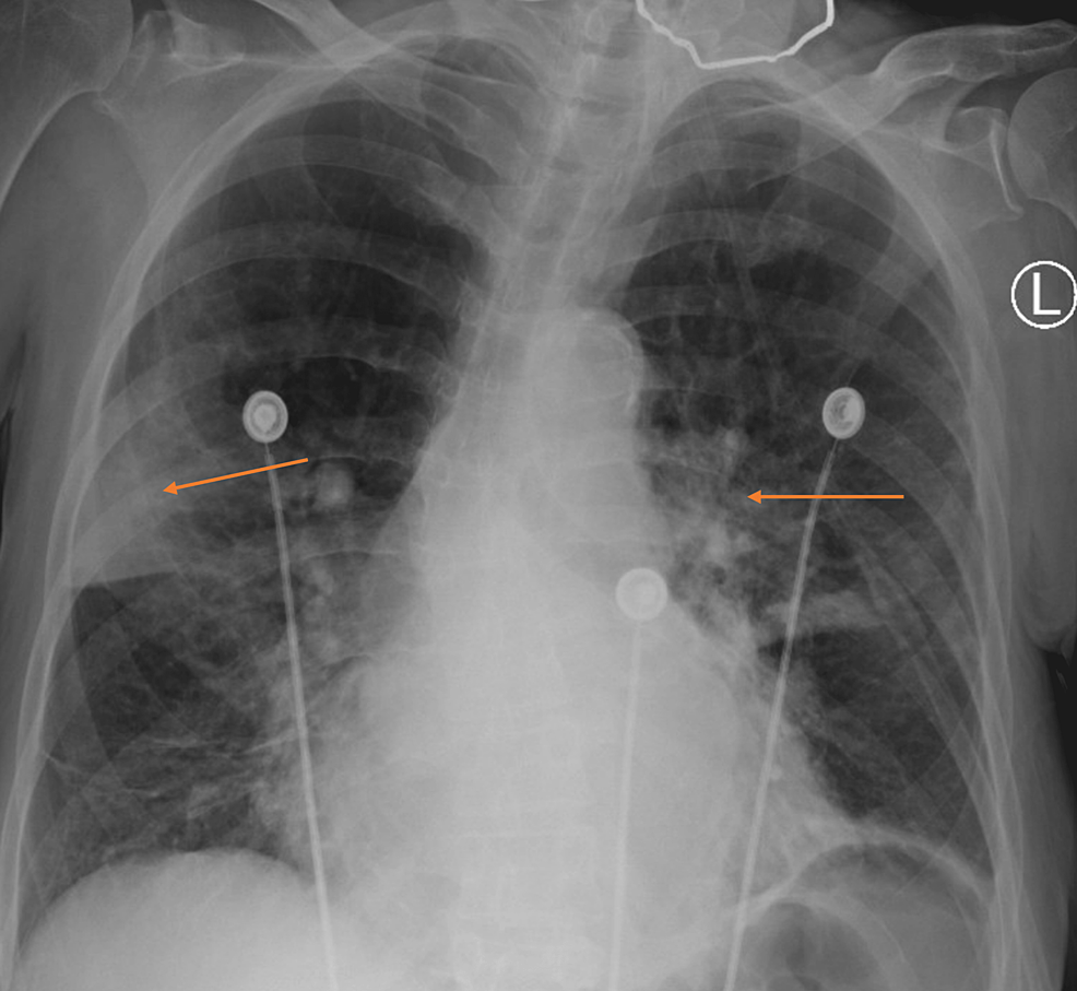 Repeat-Chest-X-Ray-Demonstrating-Improvement-in-Bilateral-Lung-Opacification-(arrows).