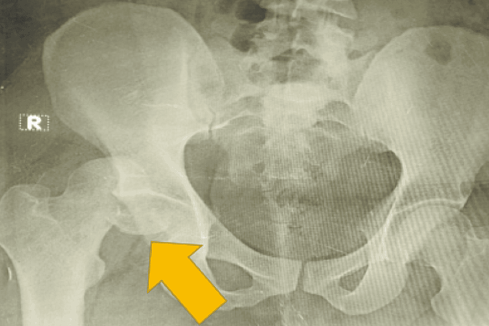 Can A Femoral Head Fracture Heal On Its Own