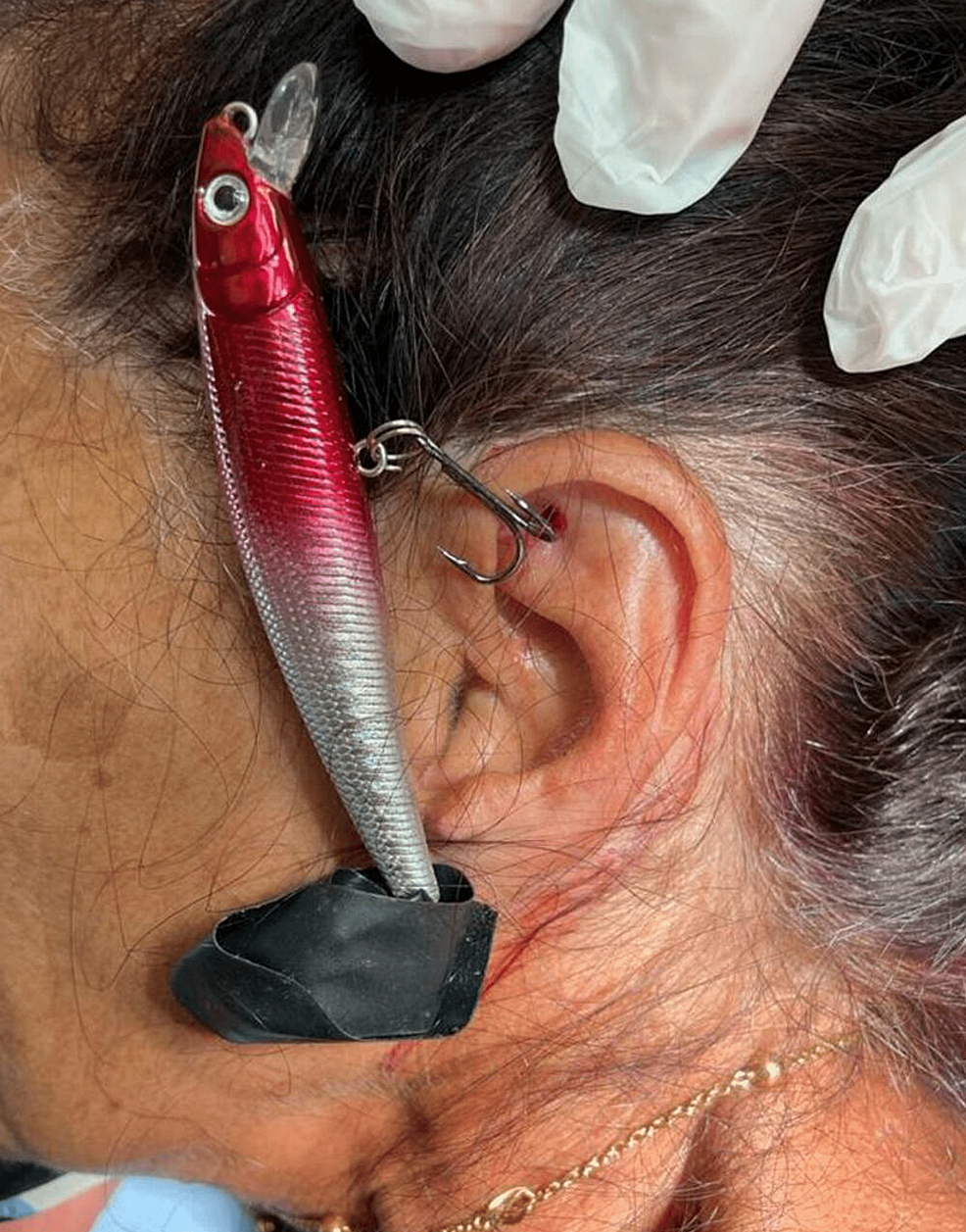 Cureus, CUT BARB (an Acronym for Fishhook Injuries): Illustrated by the  Extraction of a Fishhook From the Auricle Using the Advance-and-Cut  Technique