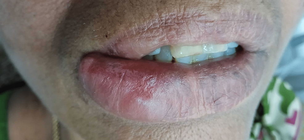 Intraoral-examination-revealed-a-diffuse-swelling-involving-the-right-side-vermilion-border-of-the-lip