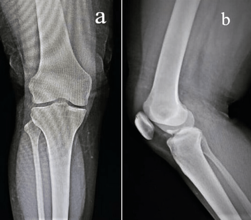 Synovial ChondromatosisInduced Monoarticular Knee Arthritis