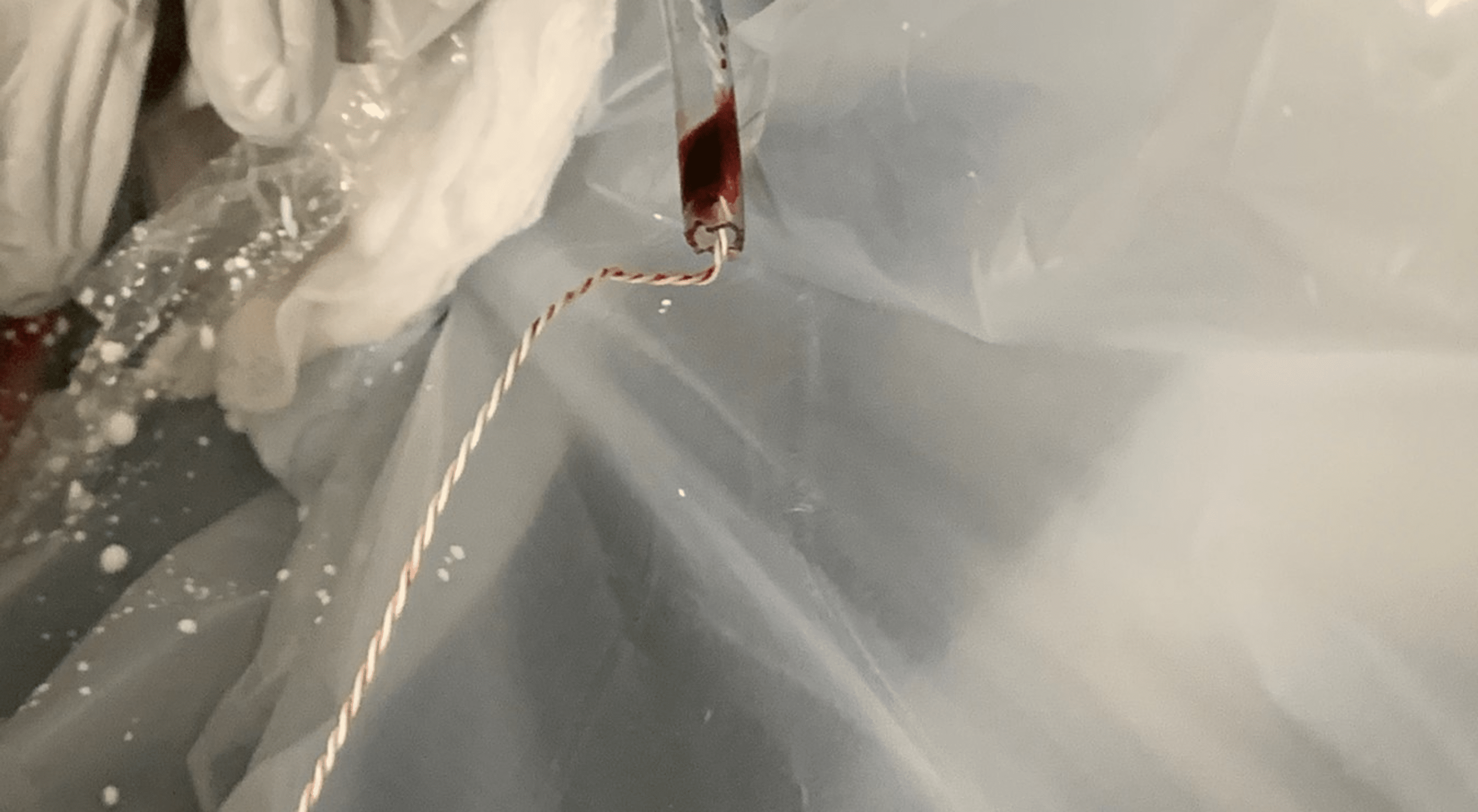 Cureus Complications From Operator Modification of the Esophageal