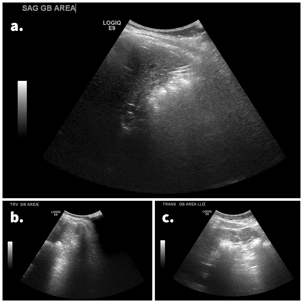 Cureus | Preoperative Diagnosis of Gallbladder Agenesis: A Case Report