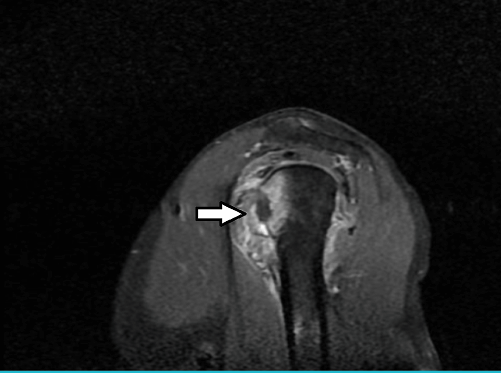 MRI-of-the-right-shoulder-joint-in-the-coronal-plane-indicated-by-the-arrow.