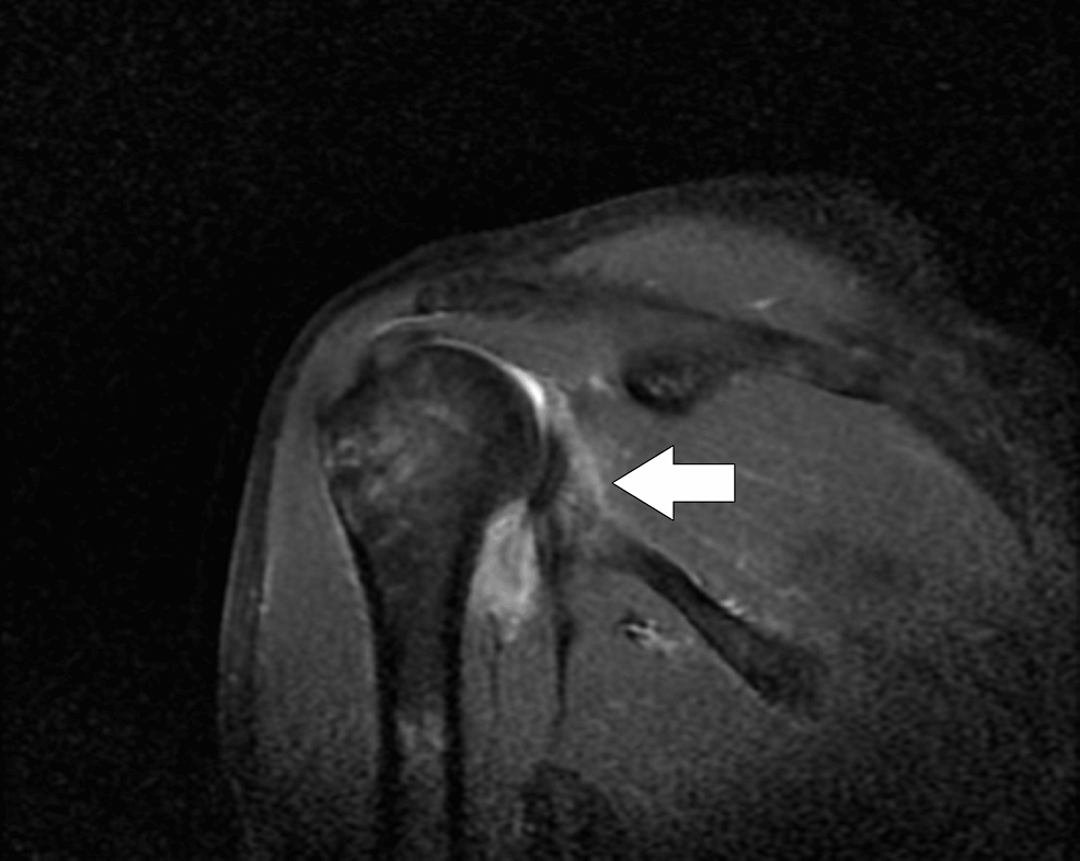 MRI-of-the-right-shoulder-joint-taken-in-the-sagittal-plane-indicated-by-the-arrow.