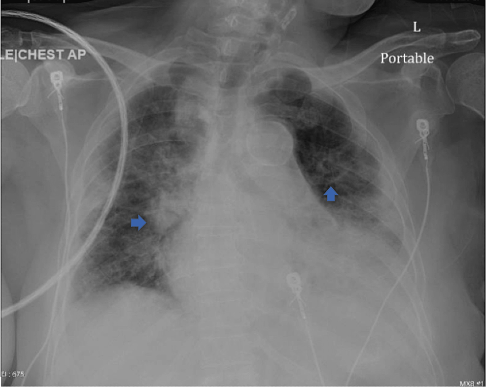 Infarctus aigu du myocarde et fibrillation auriculaire associés à la