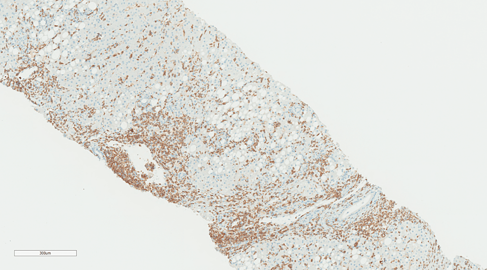 Immunohistochemistry-of-CD3-cells-showing-most-of-the-infiltration-by-T-lymphocytes-(IHC-original-magnification-x-300)