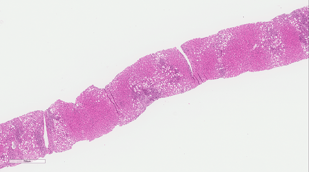 Low-power-of-liver-tissue-shows-vague-nodularity-with-moderate-steatosis-primarily-affecting-Zone-3-and-extending-to-Zone-2-as-well-as-some-amount-of-inflammation-involving-the-portal-tracts-(H&amp;E-original-magnification-x-100)