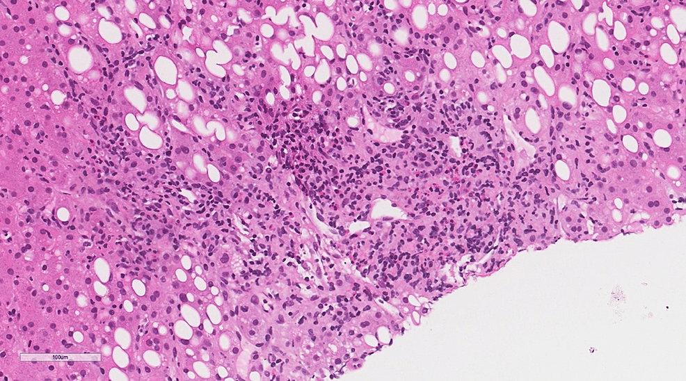 Higher-power-on-portal-tracts-shows-portal-and-periportal-lobular-inflammation-with-the-presence-of-a-large-number-of-granulomas,-most-of-which-qualify-for-the-morphological-features-of-lipogranulomas-(presence-of-fat-vacuoles-surrounded-by-epithelioid&nbsp;histiocytes-and-some-eosinophils).-Some-granulomas-show-numerous-eosinophils&nbsp;(H&amp;E-original-magnification-x-400).