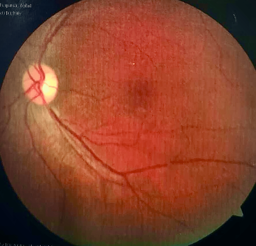 Cureus A Case of a 23YearOld Male With Leber Hereditary Optic