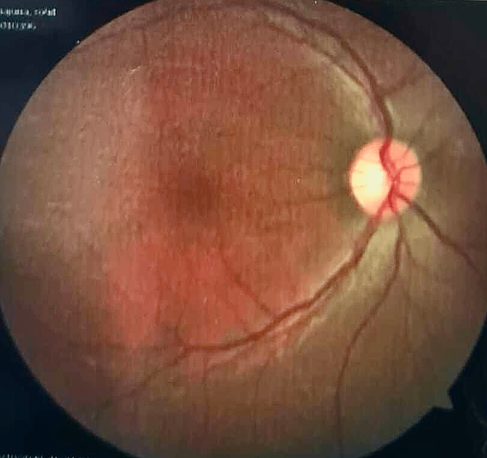 Cureus A Case of a 23YearOld Male With Leber Hereditary Optic