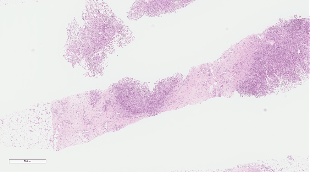 Low-power-magnification-of-a-core-needle-biopsy-specimen-of-breast-tissue-showing-multiple-granulomas-(hematoxylin-and-eosin-stain,-original-magnification-x-100).