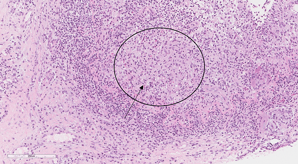 Higher-power-magnification-of-a-breast-tissue-biopsy-specimen-showing-non-necrotizing-granulomatous-inflammation-centered-on-lobules-(black-arrow),-with-lymphocytes,-plasma-cells,-epithelioid-histiocytes,-scattered-multinucleated-giant-cells,-and-neutrophils-(hematoxylin-and-eosin-stain,-original-magnification-x-400).