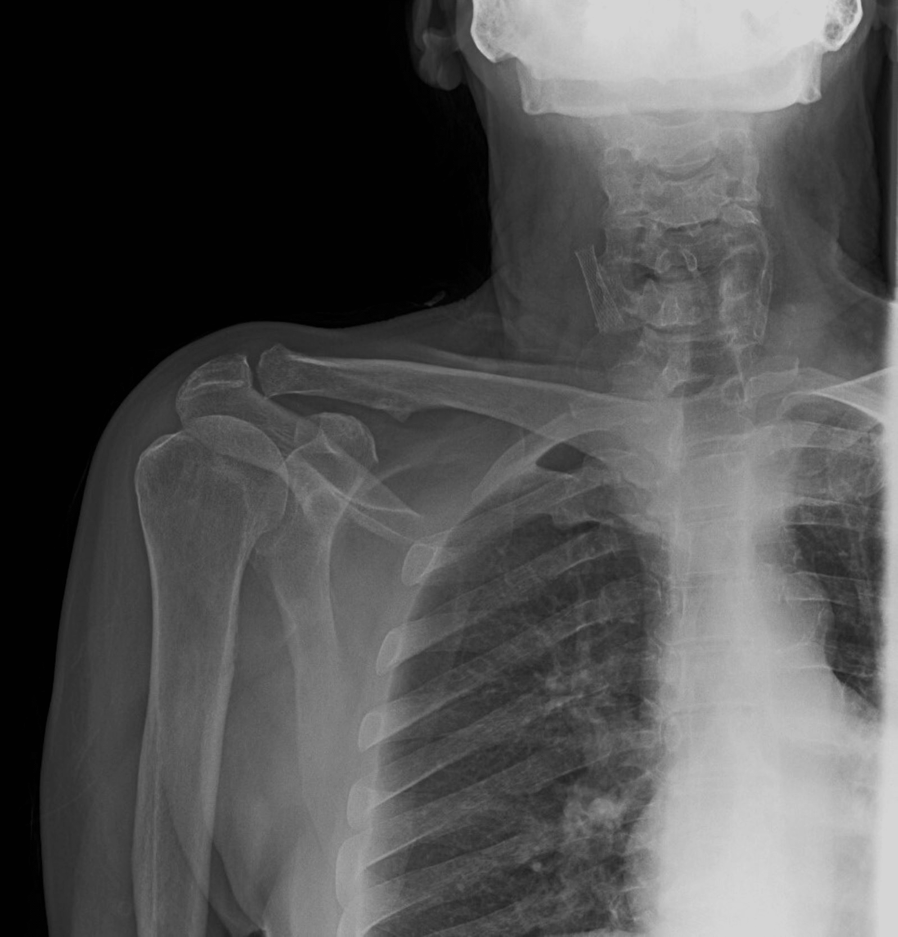 Interpreting Shoulder X Rays Image Teachmeanatomy - Vrogue.co