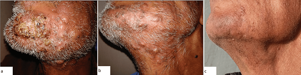 Tinea-barbae-with-kerion-on-the-chin.-Notice-inflammatory-plaques-with-pustules-and-crusts.-