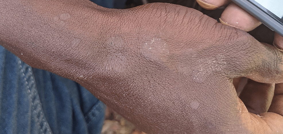 Tinea-versicolor-of-the-hand.