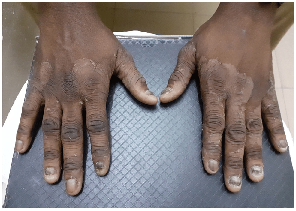 Peeling,-dryness,-and-scale-in-tinea-manuum.