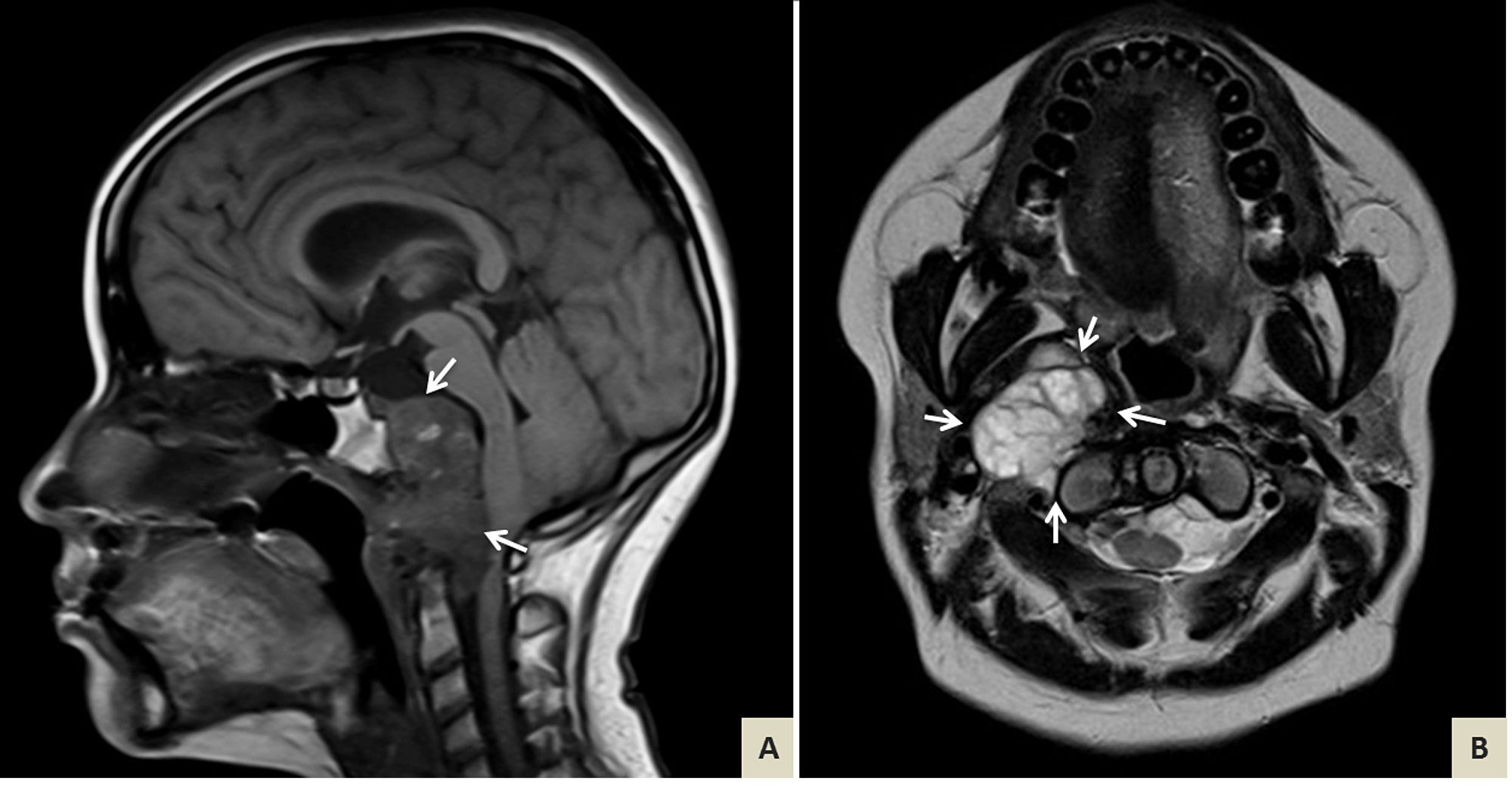 Cureus | Clival Chondroid Chordoma: A Case Report and Review of the ...