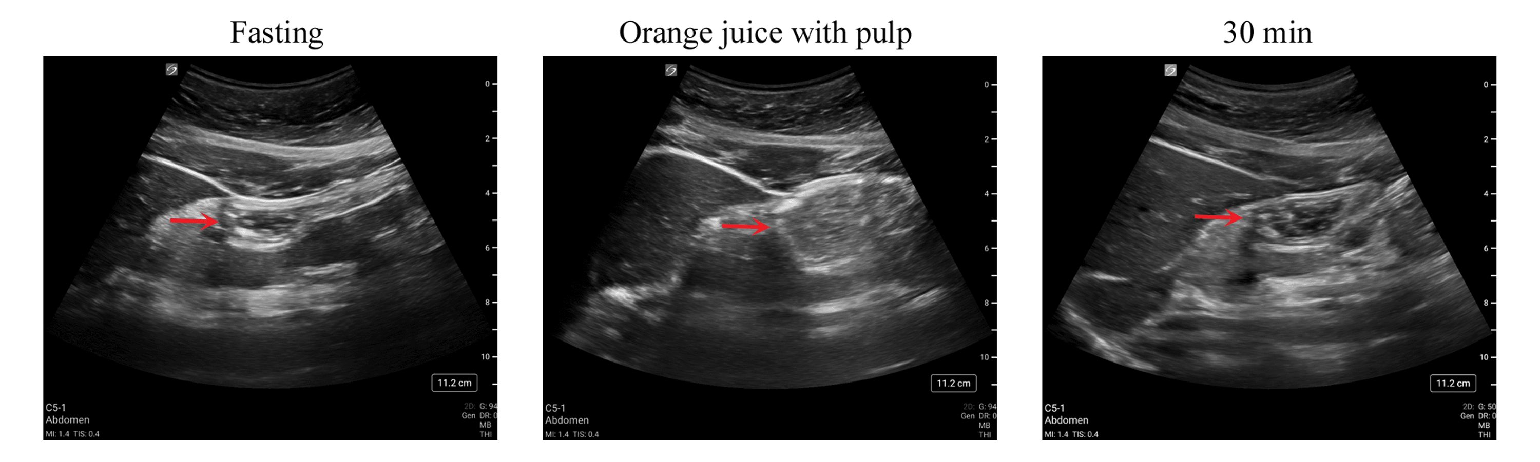 Cureus Gastric Emptying of Orange Juice With and Without Pulp A PointofCare Ultrasound Study