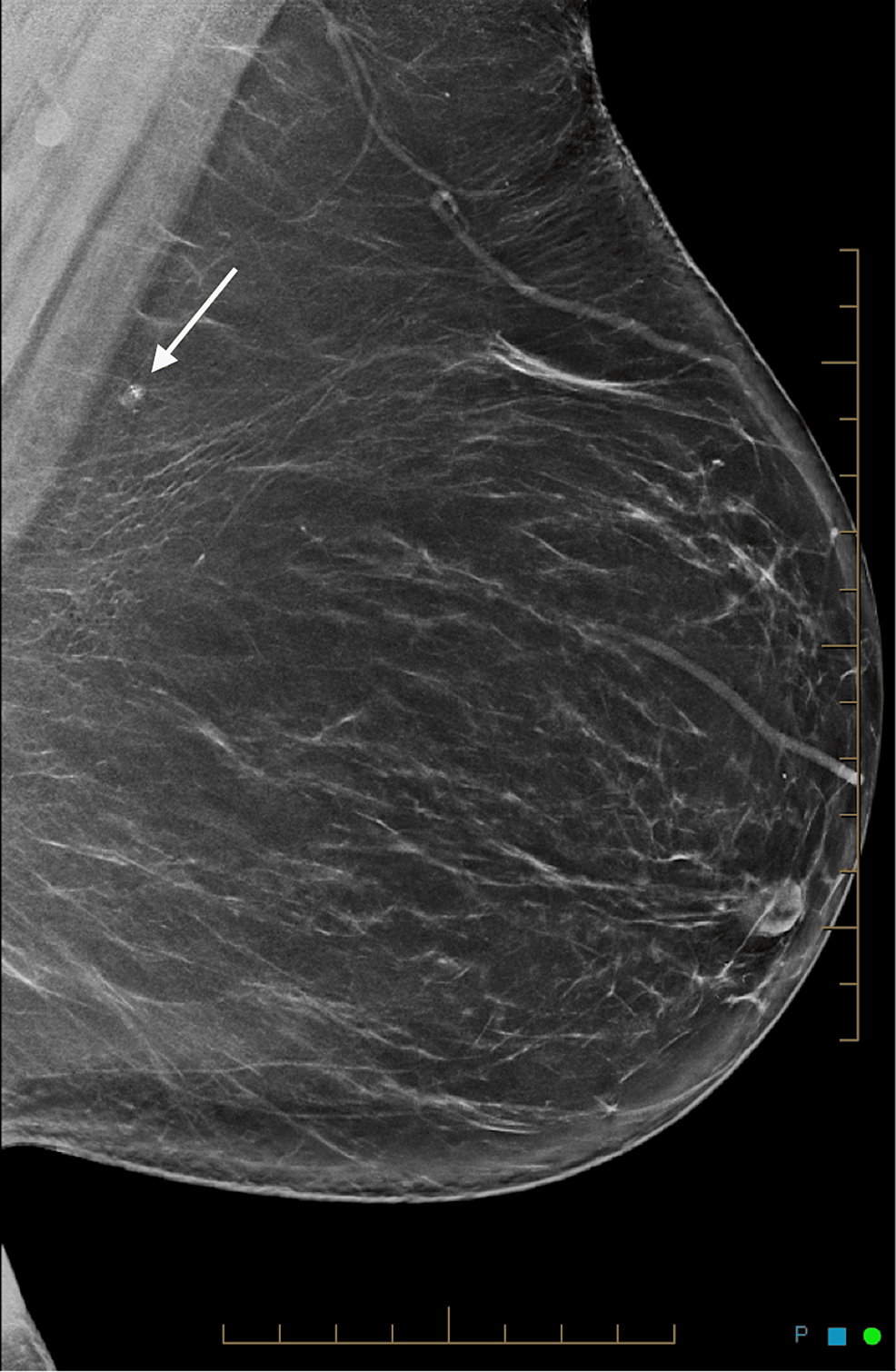 Cureus Tattoo Pigment In An Intramammary Lymph Node Mimicking Breast cureus-tattoo-pigment-in-an-intramammary-lymph-node-mimicking-breast