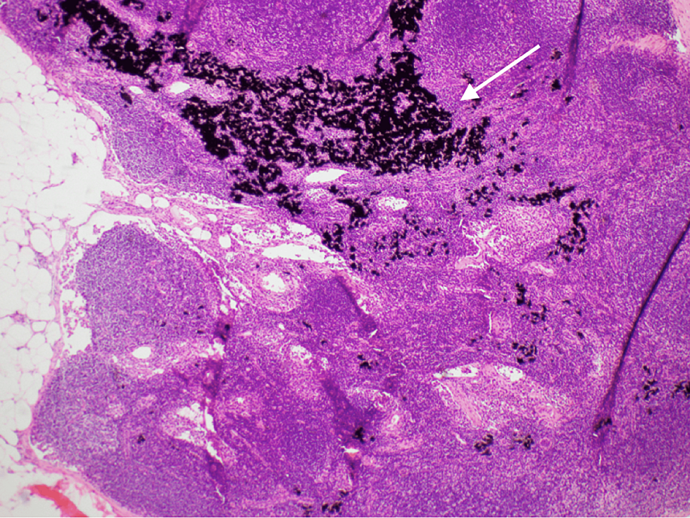 Cureus Tattoo Pigment in an Intramammary Lymph Node Mimicking Breast