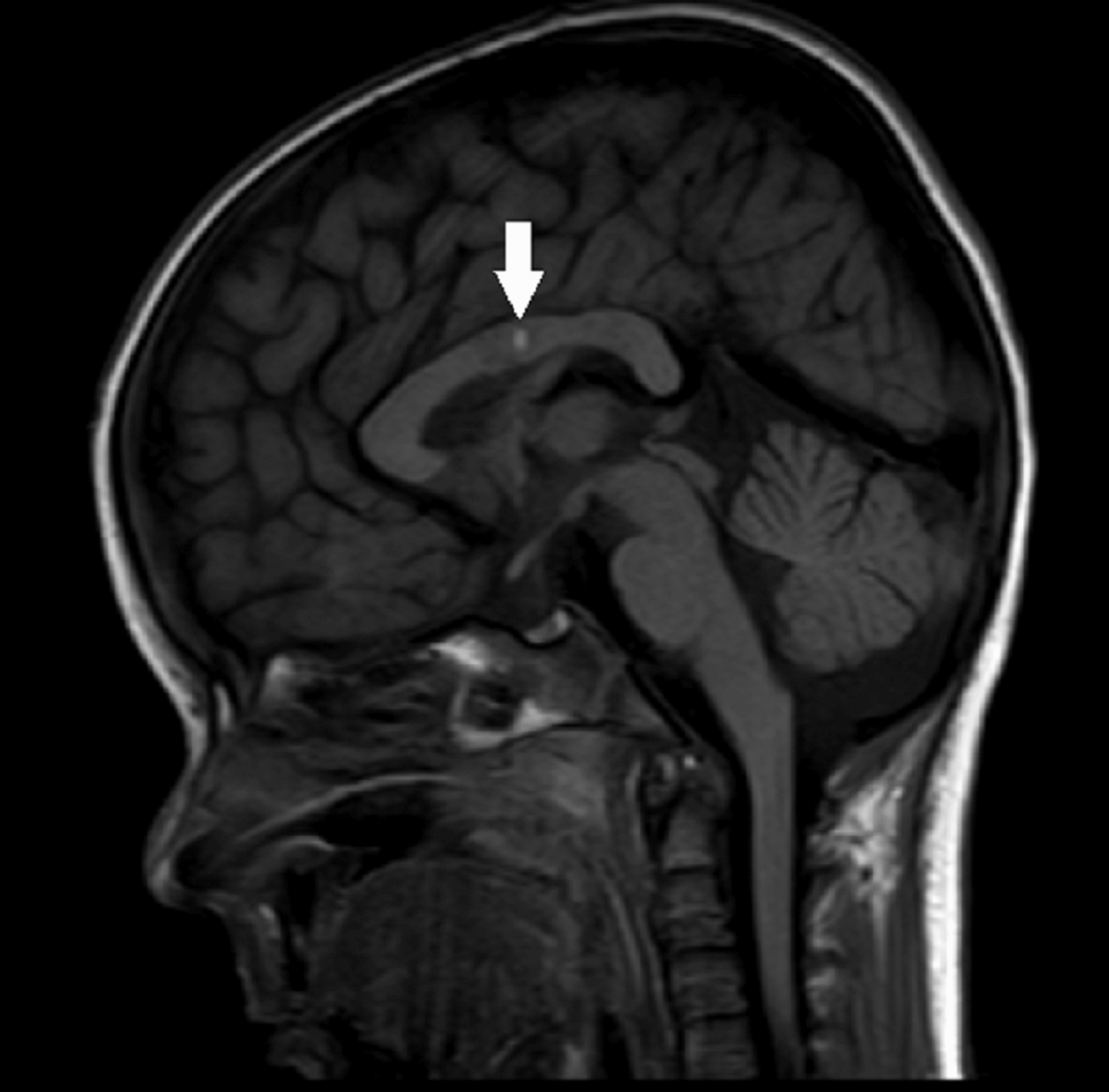 Cureus | Corpus Callosum Infarct in the Background of Varicella-Zoster ...