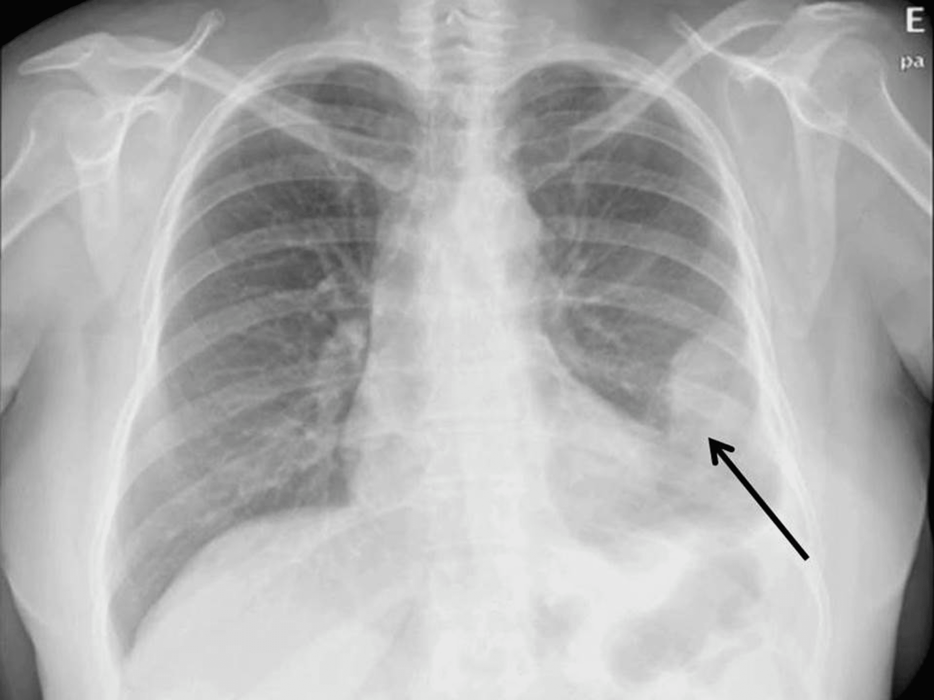 Cureus A Case Report of Mesothelioma Response to Endocrine Therapy in