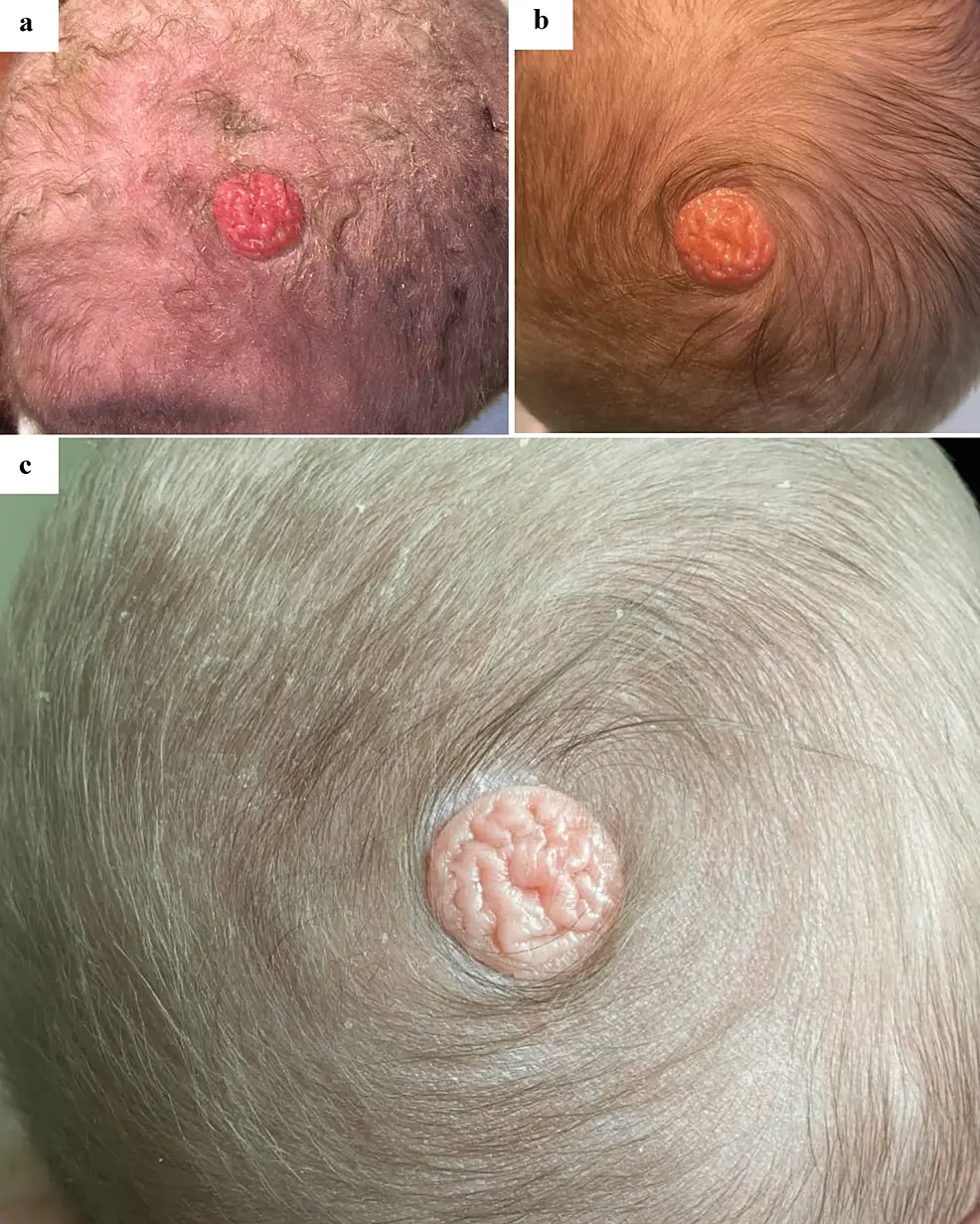 Cureus | Nevus Sebaceus Arising Within a Scalp Whorl of a Healthy Male  Neonate | Article