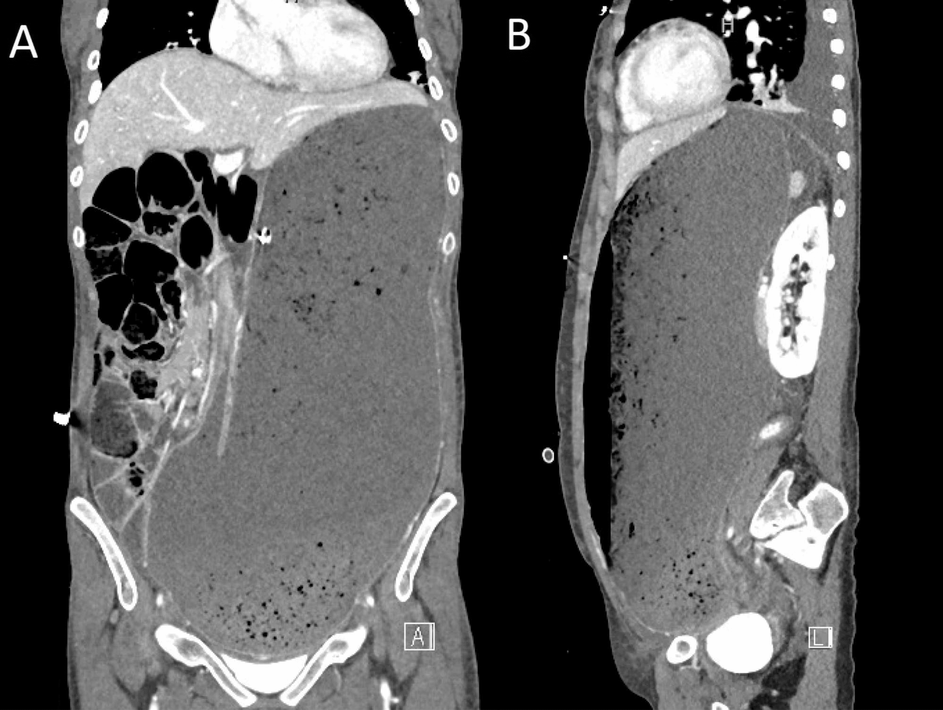 Cureus Acute Gastric Dilatation Complicated By Necrosis And Perforation Following A Binge