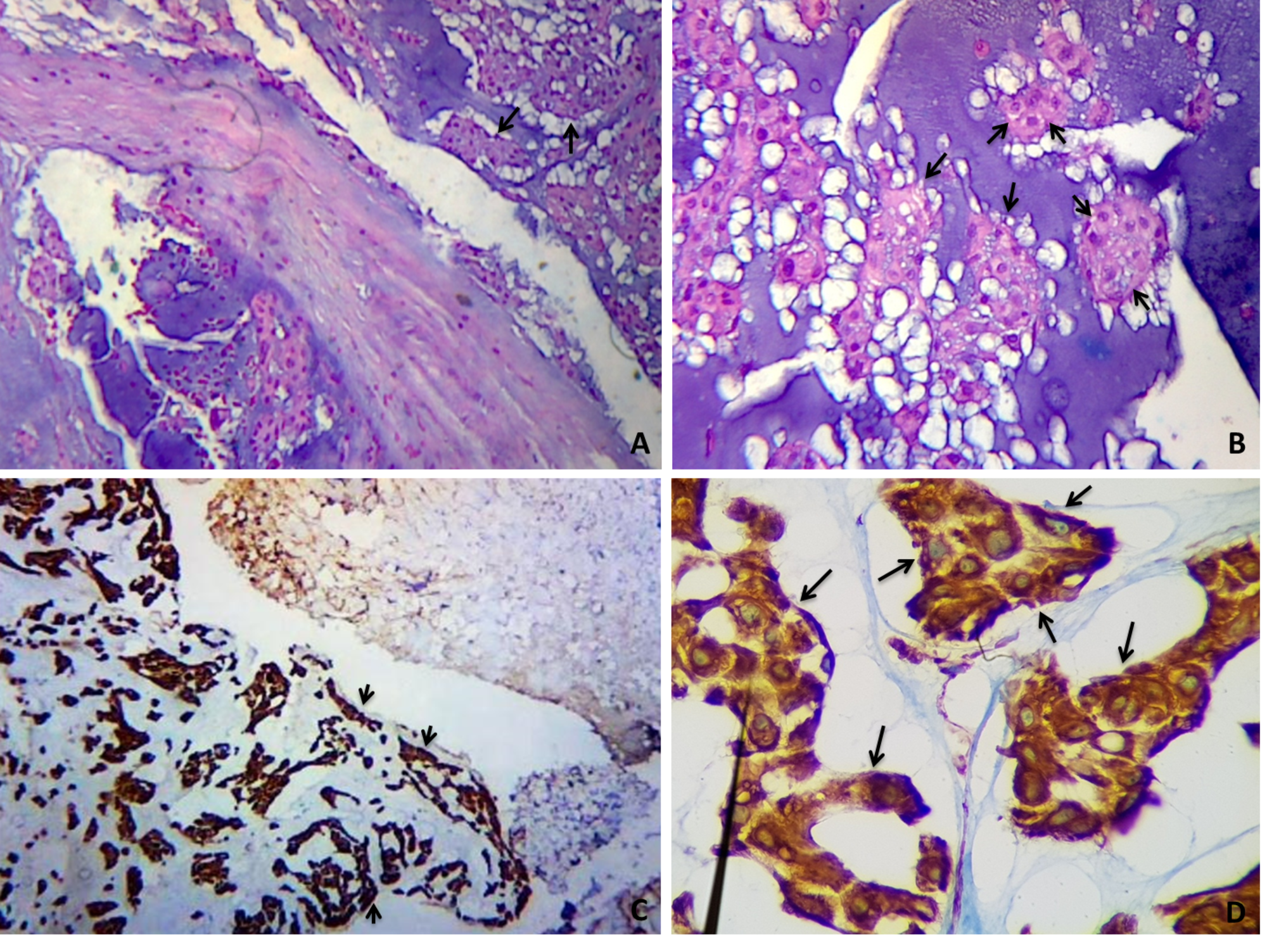 Cureus Clival Chondroid Chordoma A Case Report And Review Of The Literature 0362