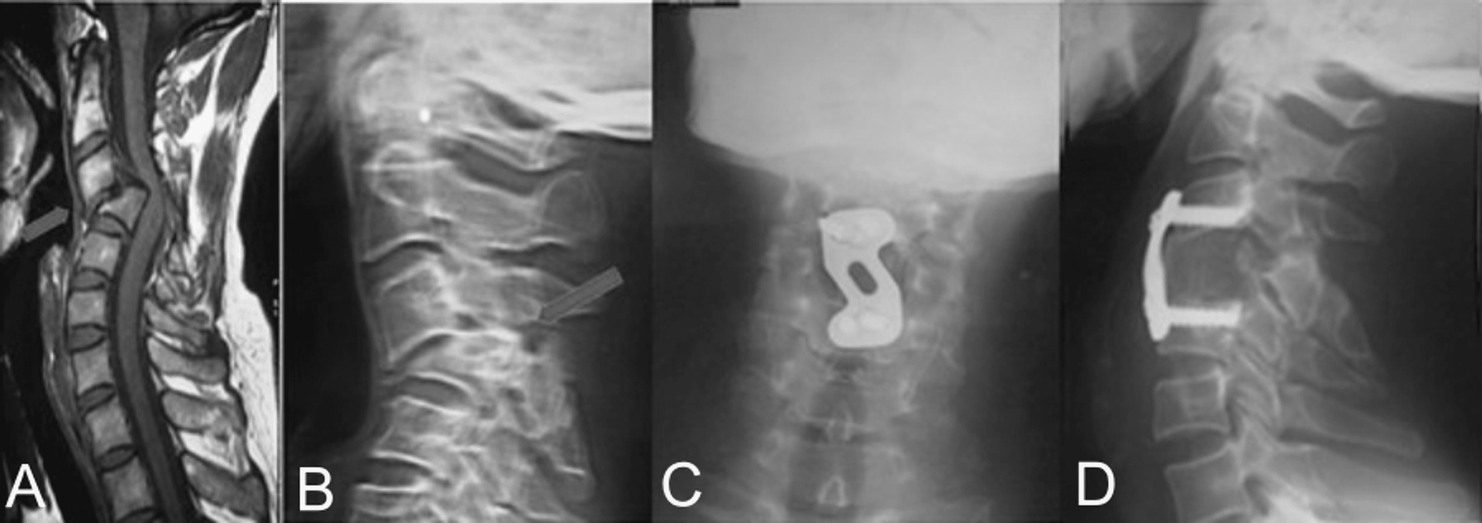 Efficacy, Safety, And Reliability Of The Single Anterior Approach For ...