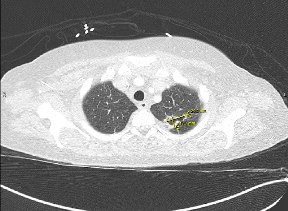 -CT-scan-of-the-chest-(axial-slice,-lung-window)-showing-septic-embolus-to-left-lung-field.