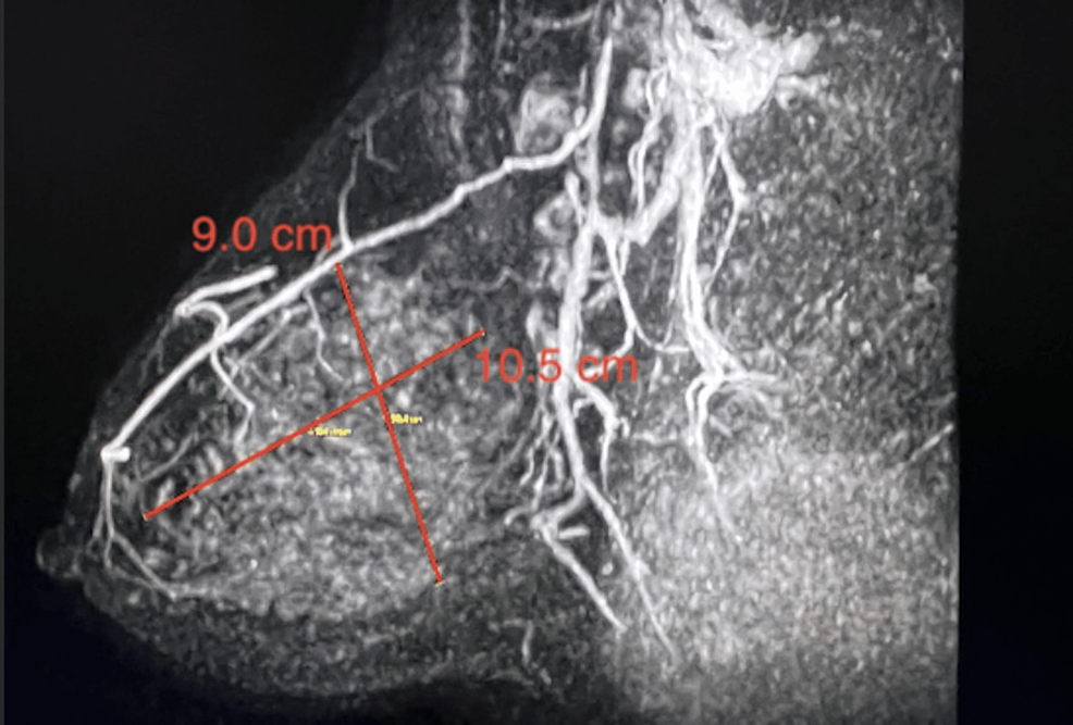 Cureus The Use of MRI to Detect Malignancy in a Patient Presenting
