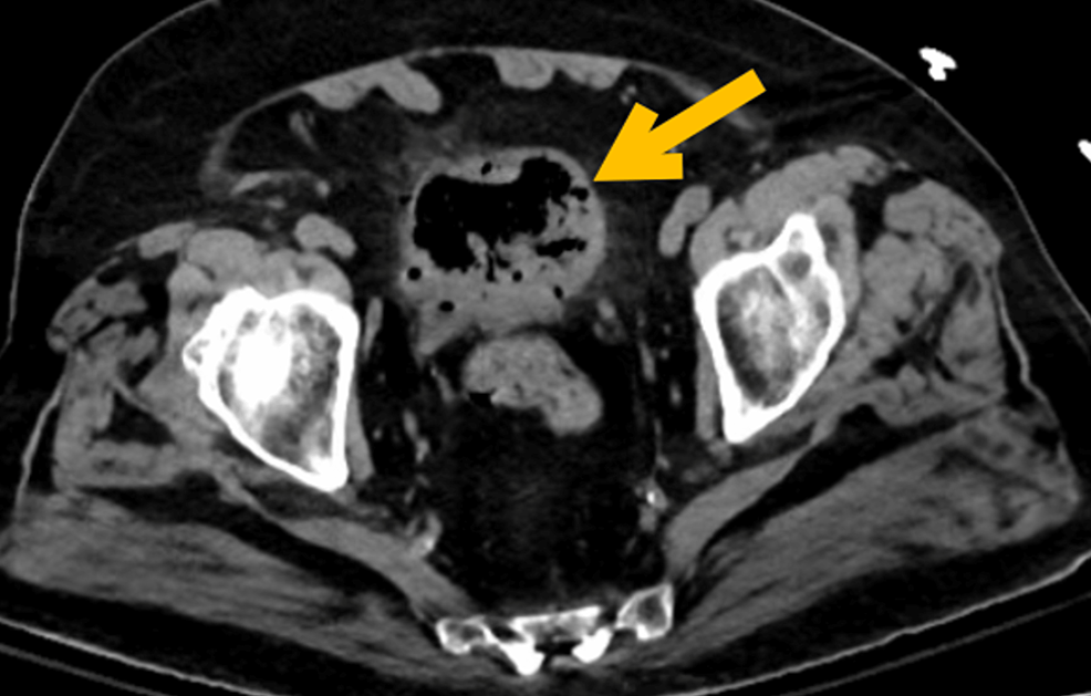 Emphysematous Cystitis Complicated by Pneumorrhachis