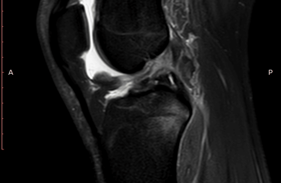 MRI-showing-anterior-cruciate-ligament-(ACL)-tear