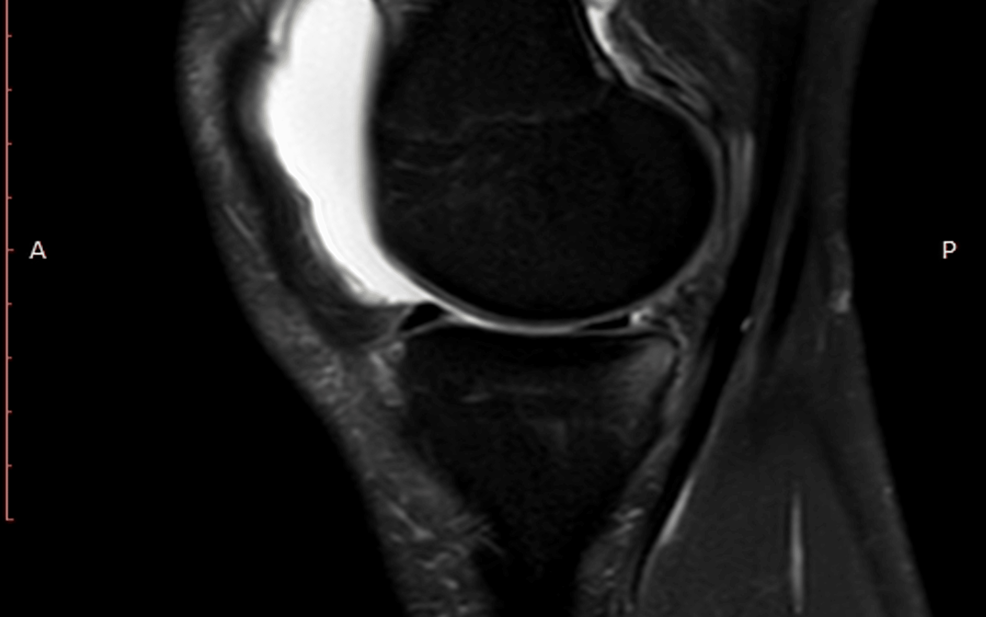 MRI-showing-ramp-lesion