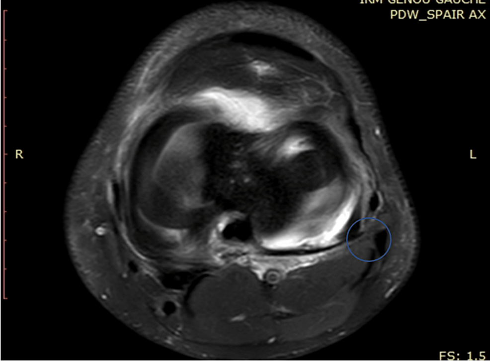 MRI-showing-the-proximity-of-the-semimembranosus-tendon-to-the-medial-meniscus