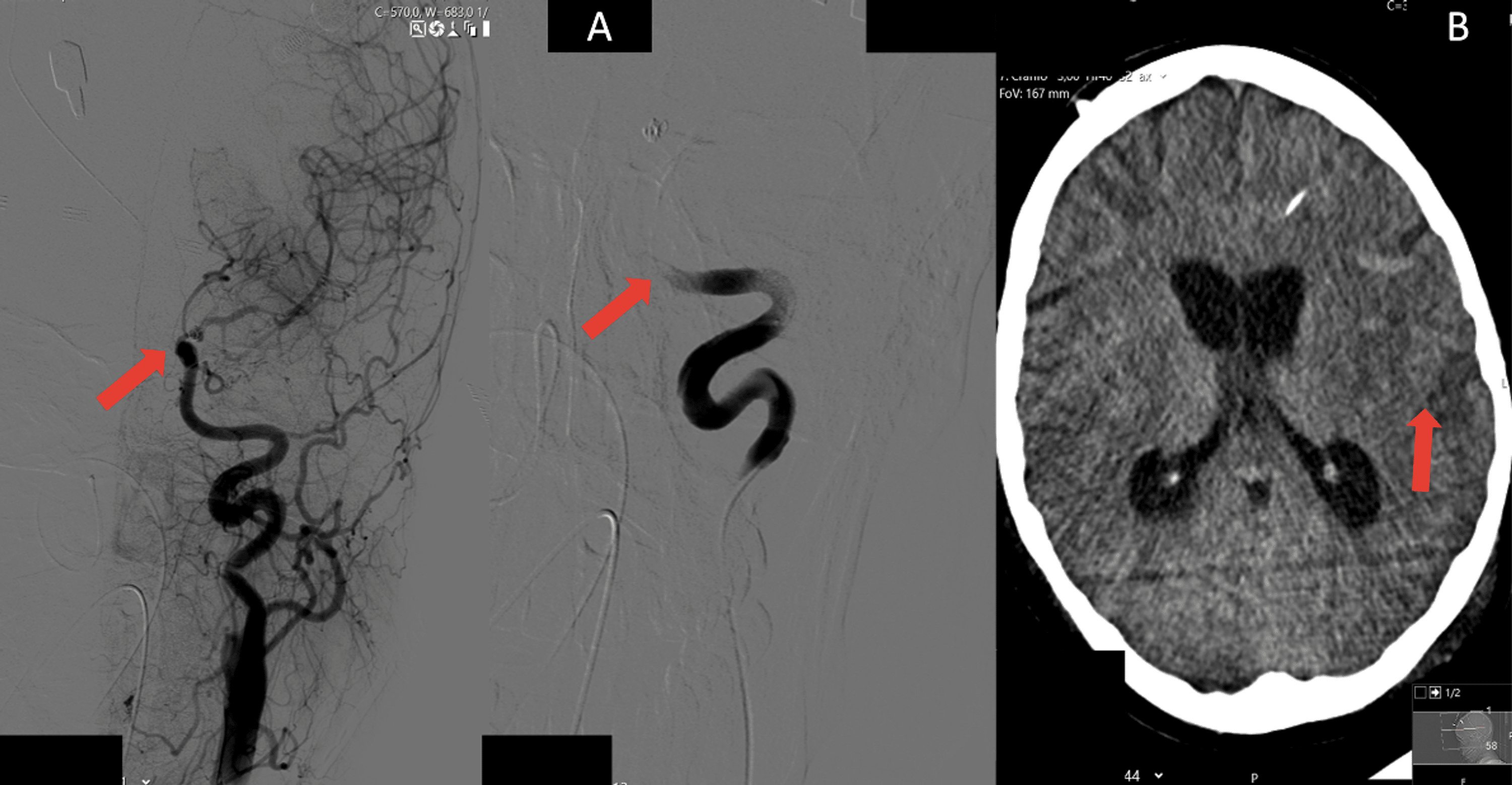 Cureus Treatment of Cerebral Vasospasm With Continuous IntraArterial