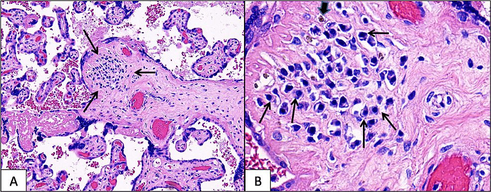 A:--A-cluster-of-plasma-cells-is-present-in-a-chorionic-villus-(arrows).-The-surrounding-chorionic-villi-are-unremarkable-(H&amp;E,-magnification-100-x).-B.-Focal-hemosiderin-(short-arrow)-is-seen-adjacent-to-the-plasma-cells-(long-arrows)-(H&amp;E,-magnification-400x)