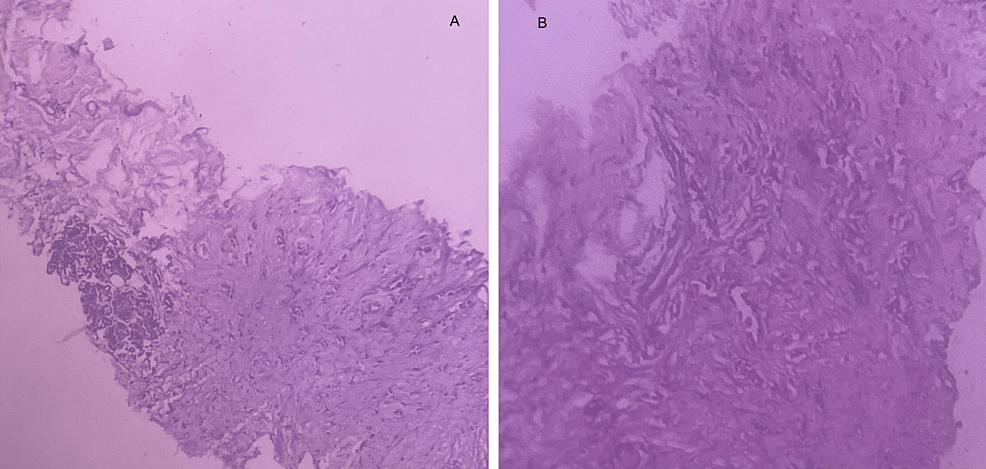Histopathology-of-right-breast-(panel-A)-and-left-breast-(panel-B)-showing-similar-histology-and-grade-of-differentiation.