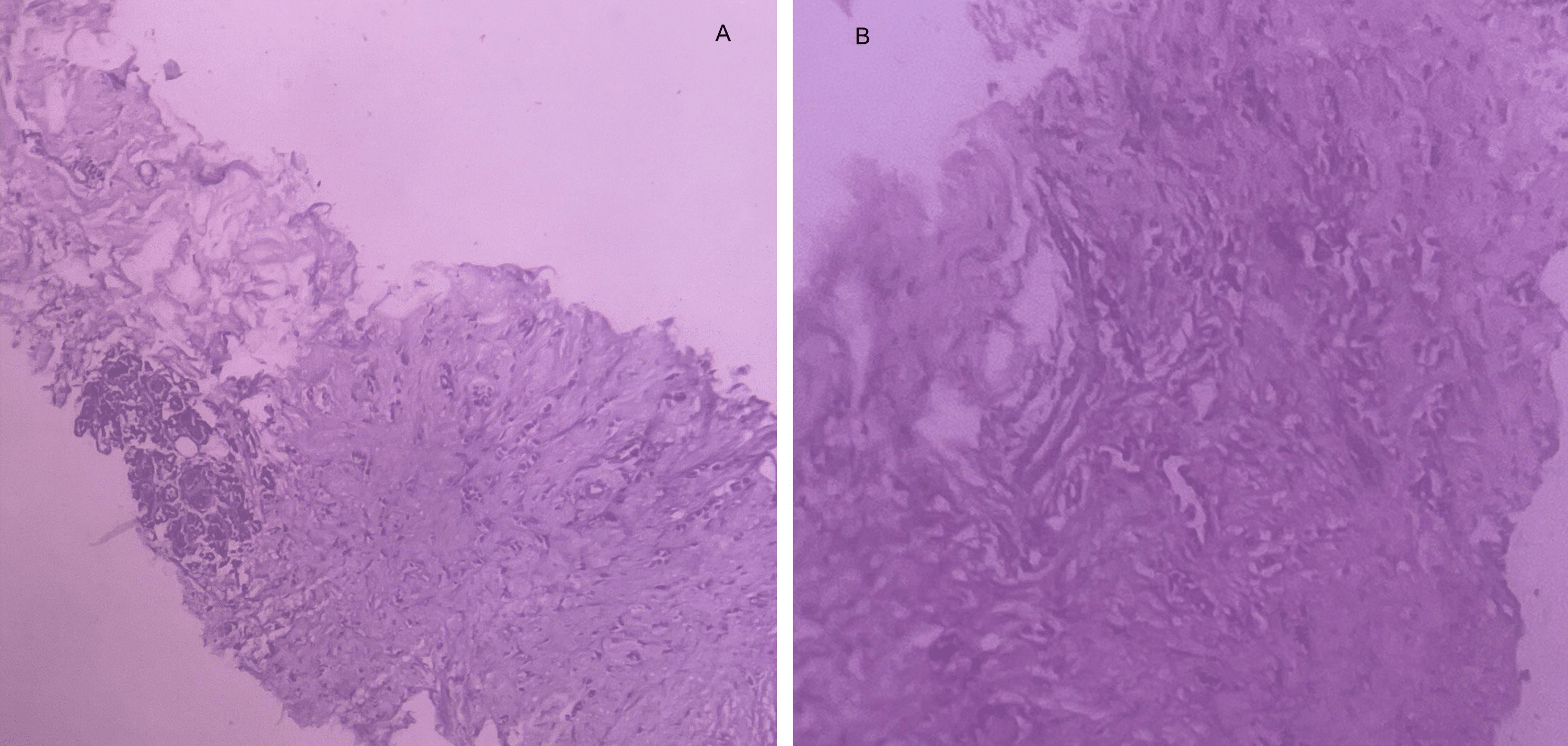 Cureus | A Case Report on Mandibular Metastasis From a Breast Carcinoma