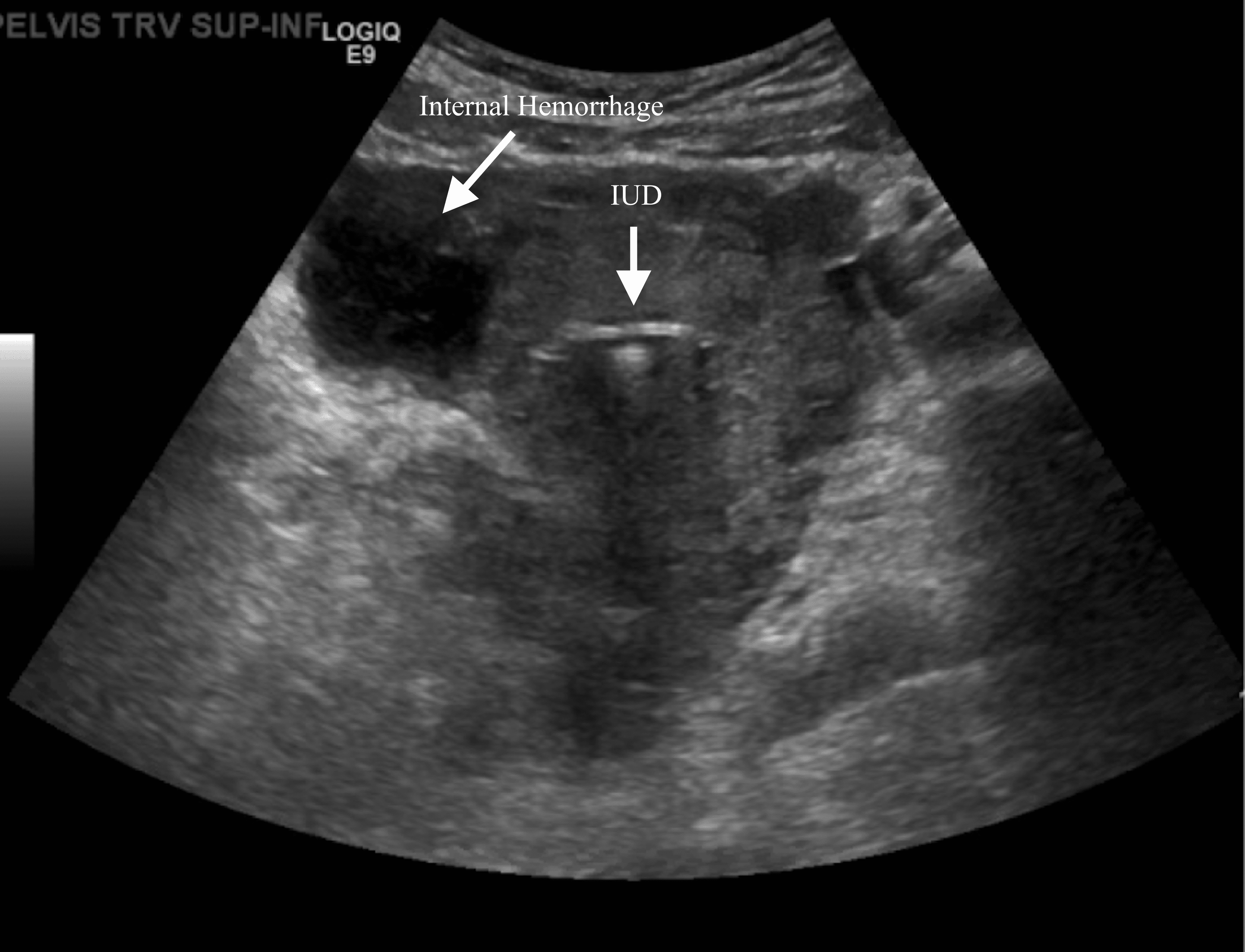 Ectopic Pregnancy Observed With Kyleena Intrauterine Device Use: A Case ...