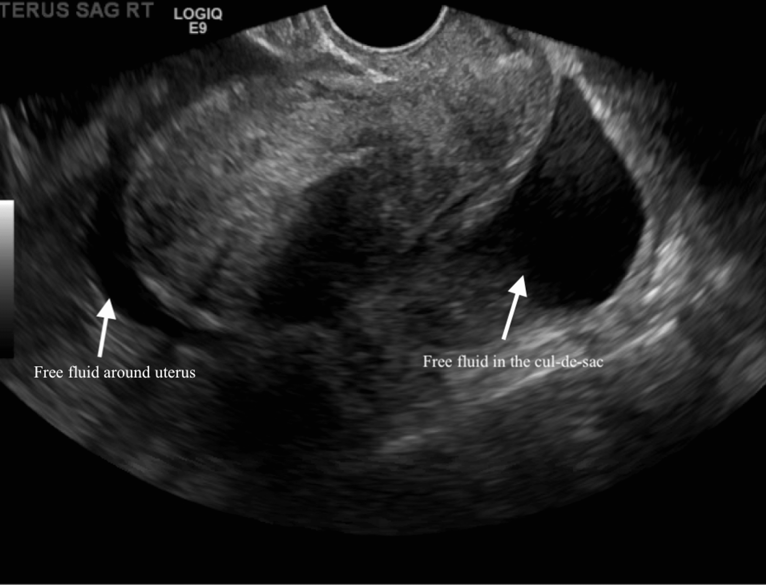 Cureus Ectopic Pregnancy Observed With Kyleena Intrauterine Device