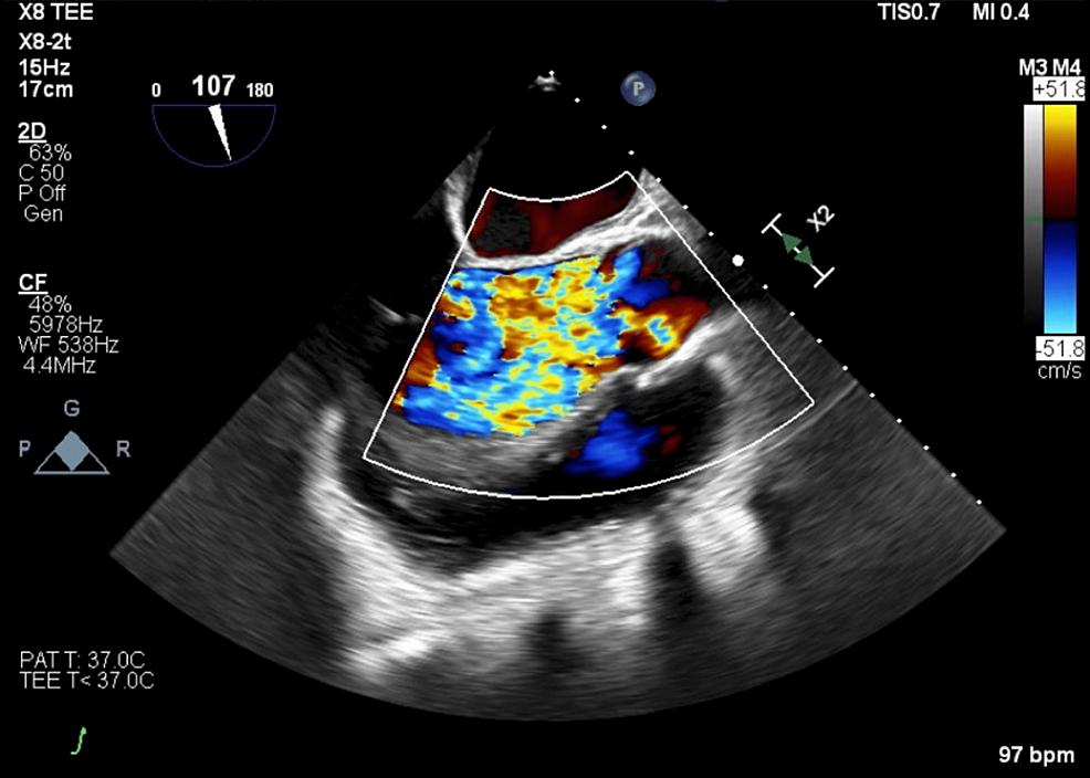an-unusual-etiology-of-aortic-insufficiency-a-case-report-cureus