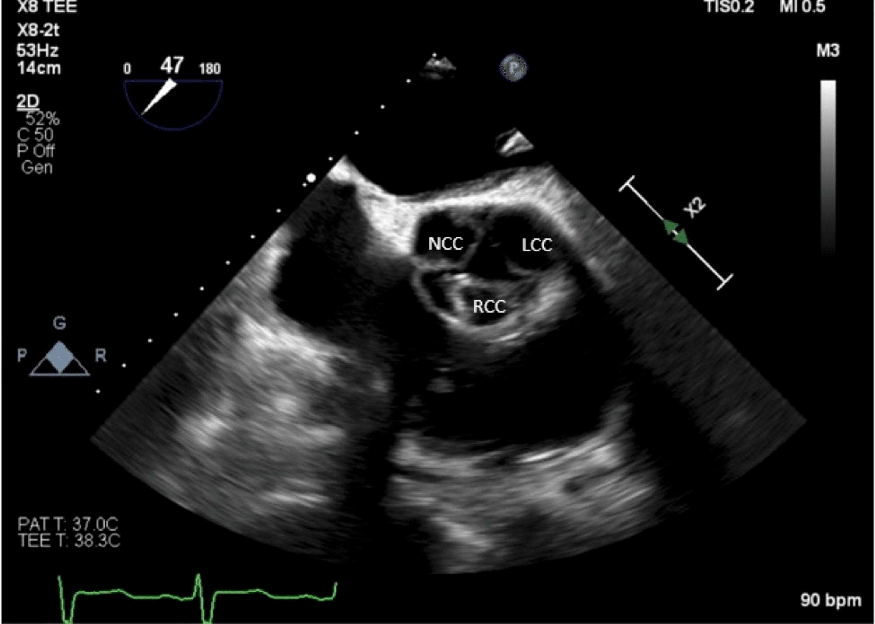 An Unusual Etiology of Aortic Insufficiency A Case Report Cureus