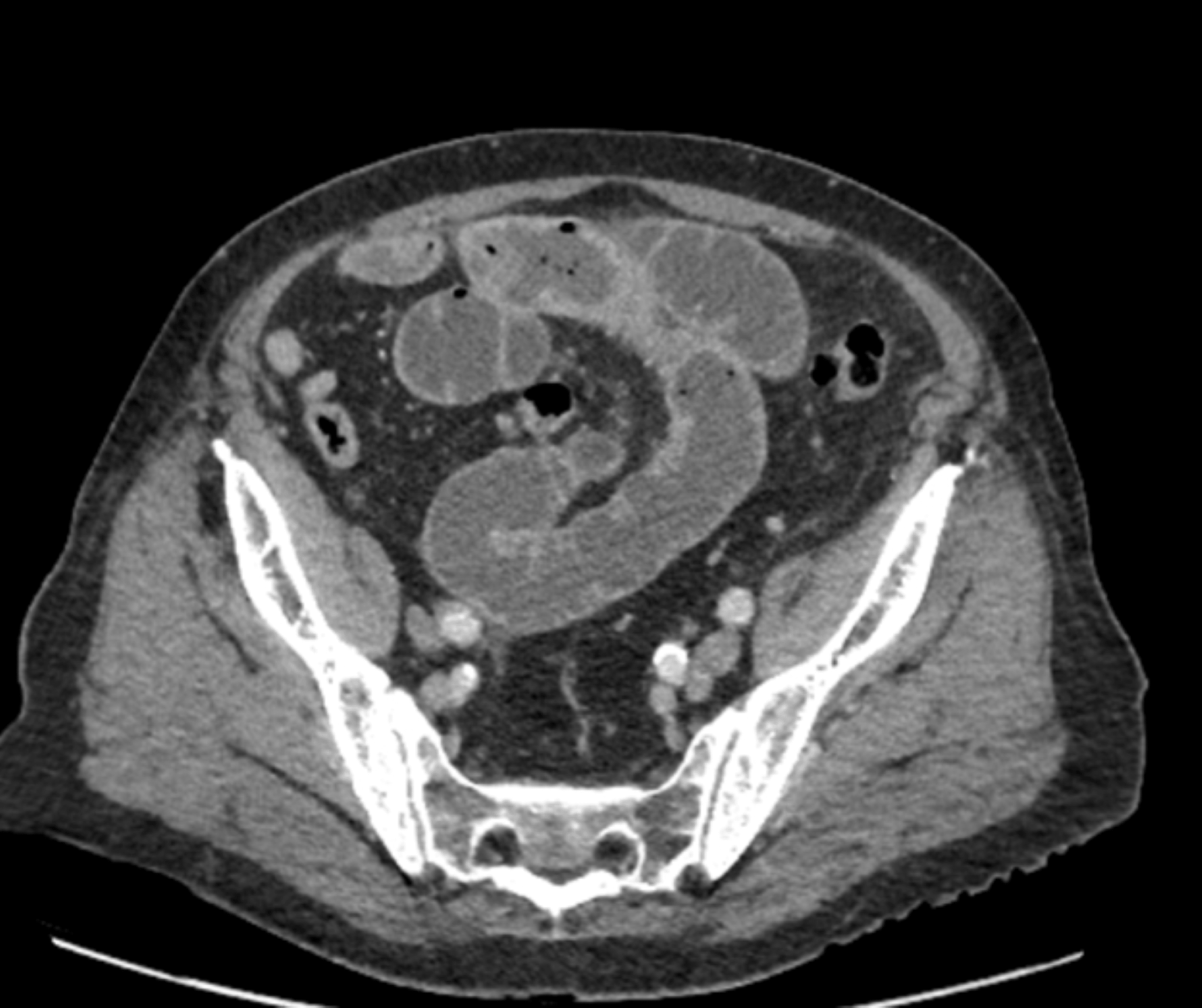 Cureus Gallstone Ileus Postcholecystectomy A Case Review