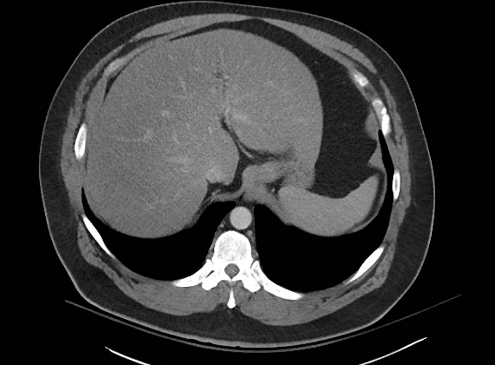 Computed-tomography-(CT)-abdomen/pelvis-showing-fatty-liver-with-no-obstruction,-masses,-or-stones.