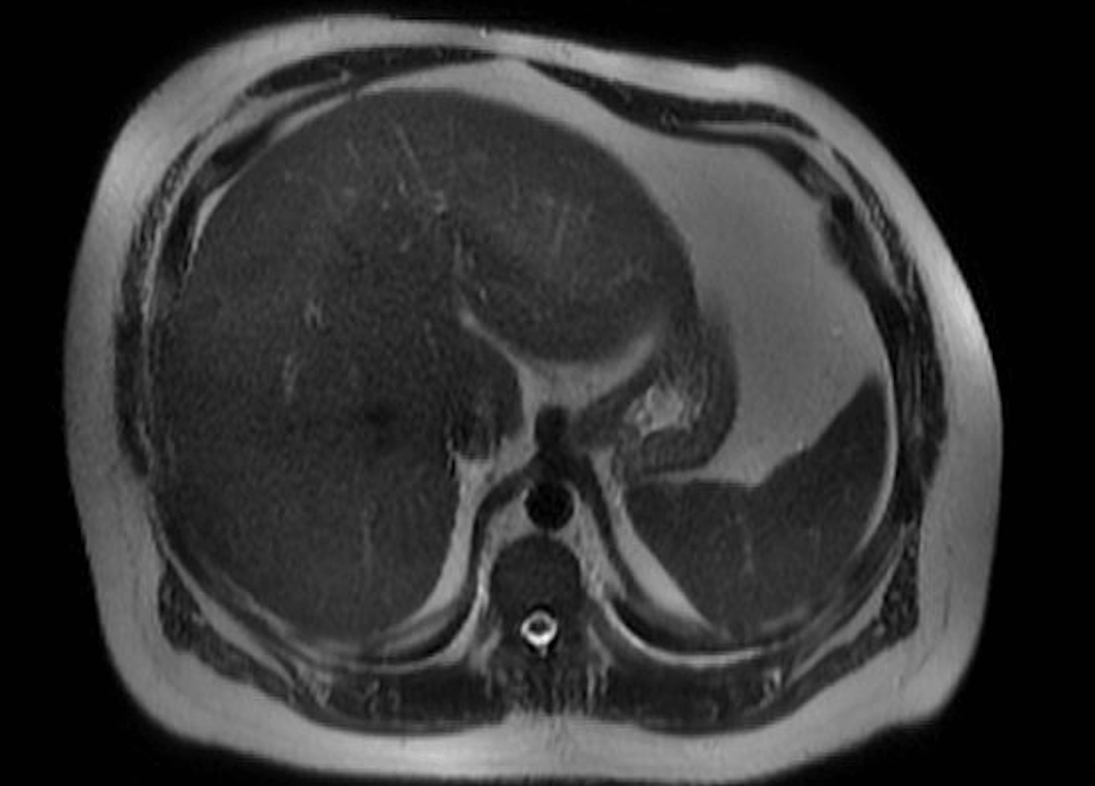 Magnetic-resonance-cholangiopancreatography-(MRCP)-showing-no-obstruction,-stones,-and-ductal-dilation.