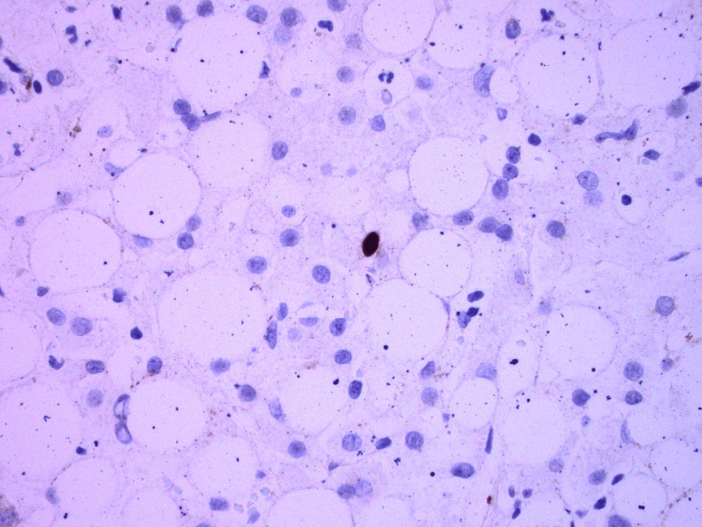 Liver-biopsy-showing-single-brown-staining-nuclei-in-the-center-positive-for-Epstein-Barr-virus.