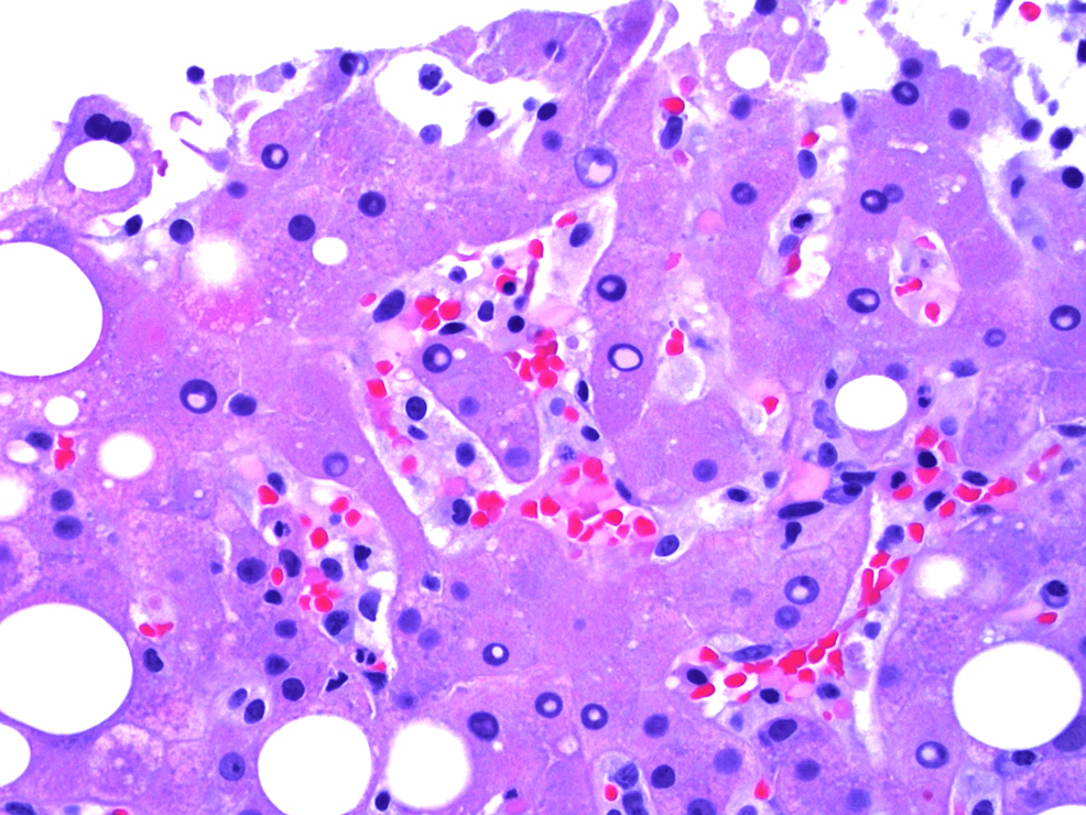 Liver-biopsy-showing-hemophagocytosis-in-sinusoids.